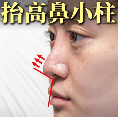 鼻小柱鼻头抬高延长神器