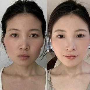 苹果肌提升精华 丰盈脸颊凹陷太阳穴泪沟法令纹修复眼窝额头饱满