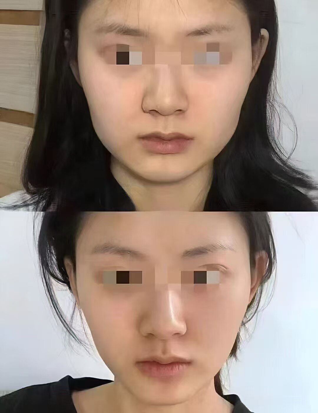 草本偏脸修复精华 改善歪脸矫正下颌线歪斜加强版