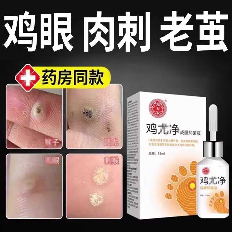 龙专家鸡尤净去鸡眼肉刺猴子扁平尤瘊子足部手部成膜液跖疣小肉粒