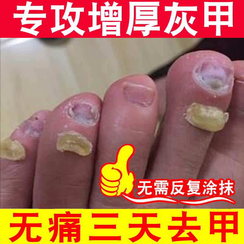 云琪灰指甲无痛脱甲膏指甲发黄脚趾甲增厚专用封包软甲膏送工具