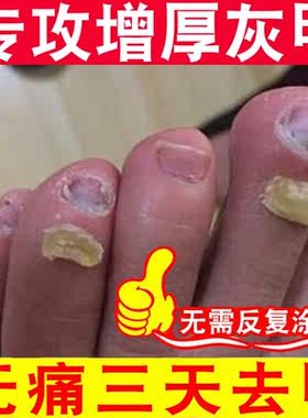 云琪灰指甲无痛脱甲膏指甲发黄脚趾甲增厚专用封包软甲膏送工具