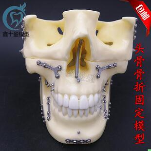 牙科种植支抗钉模型 头颅骨折固定模型 头颅骨口腔模型医学教学
