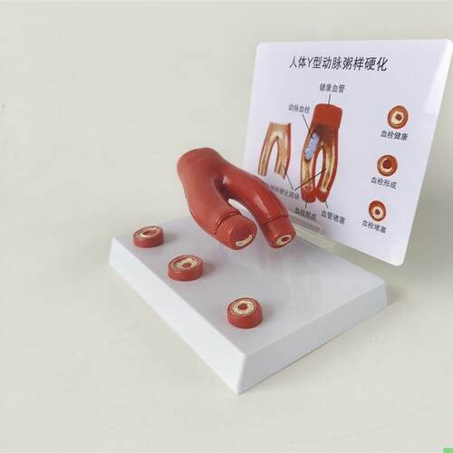 人体心脑血管动脉粥样硬化堵塞模型血栓血液脂肪病理解剖医学教具