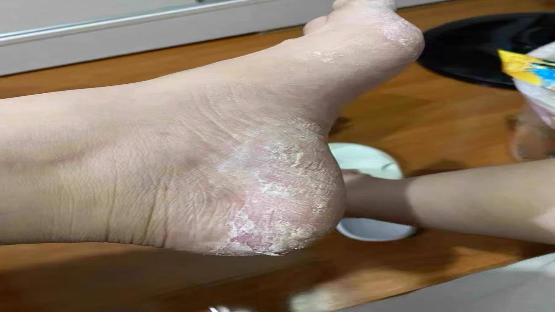 脚脱皮脚底板干燥烂水泡脚趾缝硬皮抑修护舒缓脚丫痒菌软膏