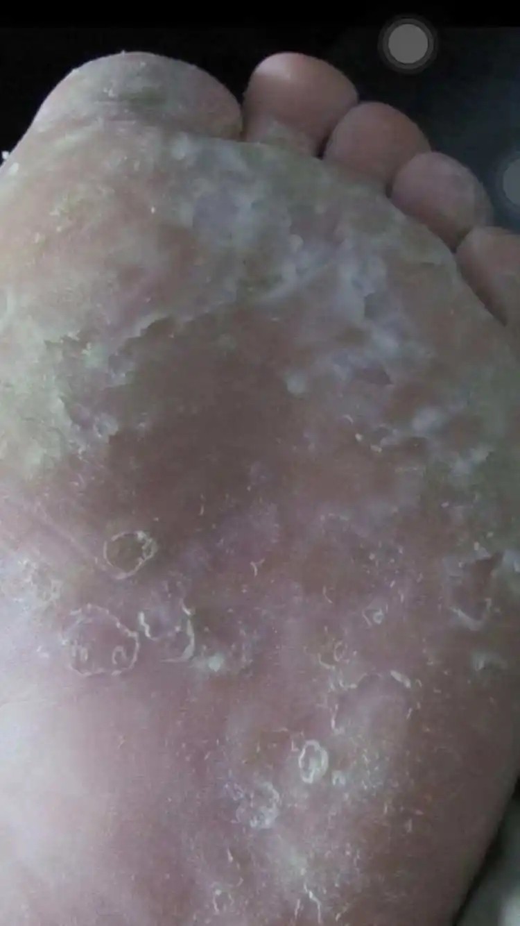 脚脱皮起泡去死皮痒脚底干燥开裂泡脚手脱皮干裂护理脚丫软膏