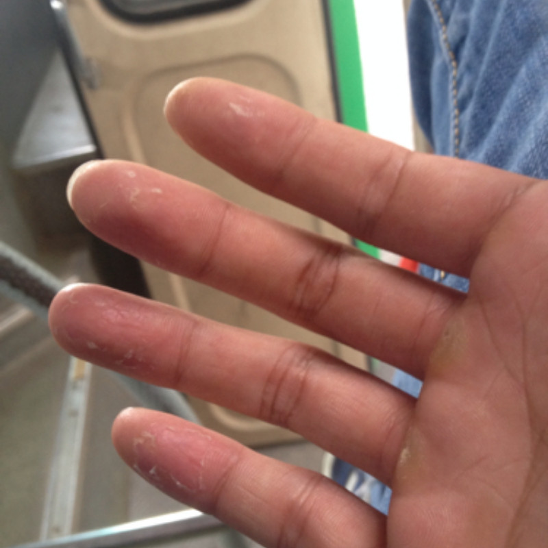 水泥过敏建筑专用手痒起泡泡皮肤痒干裂脚底裂脱皮的外用膏
