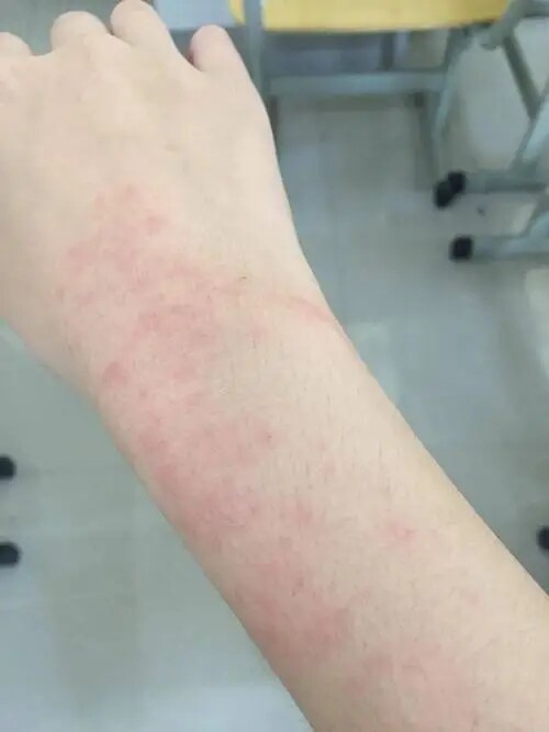 手上起疙瘩起红点水泡痒【日光性皮肤】晒伤修复晒伤晒红皮肤舒缓