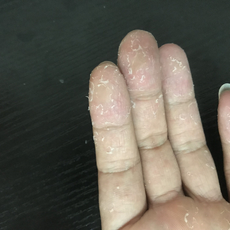 儿童手足脱皮膏手指蜕皮褪爆皮起皮掉皮手掌干裂开裂宝宝成人手脚