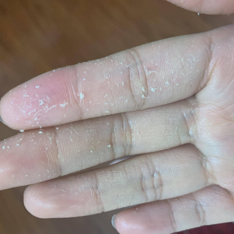 dy手脱皮修复霜季节性手掌手指头蜕皮开裂干裂维生素褪起皮掉皮爆