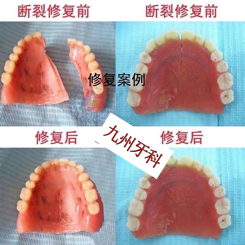 老人用全口义齿断裂了自己修复修补专用医用假牙胶水材料工具神器