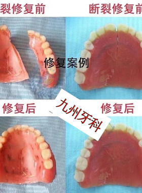 老人用全口义齿断裂了自己修复修补专用医用假牙胶水材料工具神器