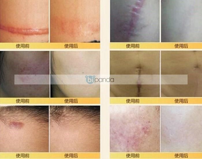 s Nuobisong face care acne scar removal cream Acne Spots sin the Video game/Fitting/Game/Raiders ,  PSP Accessories , Headset  category - from Buy2taobao.com to provide professional Taobao agent buy service