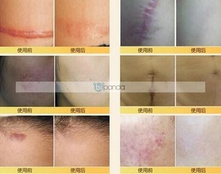 care acne Acne Nuobisong Spots cream face removal scar