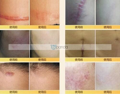 s Nuobisong face care acne scar removal cream Acne Spots s
