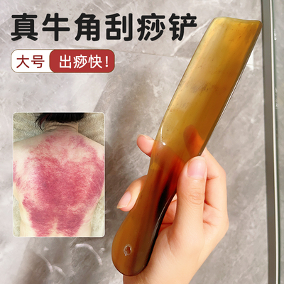 大号牛角刮痧铲！出痧快！