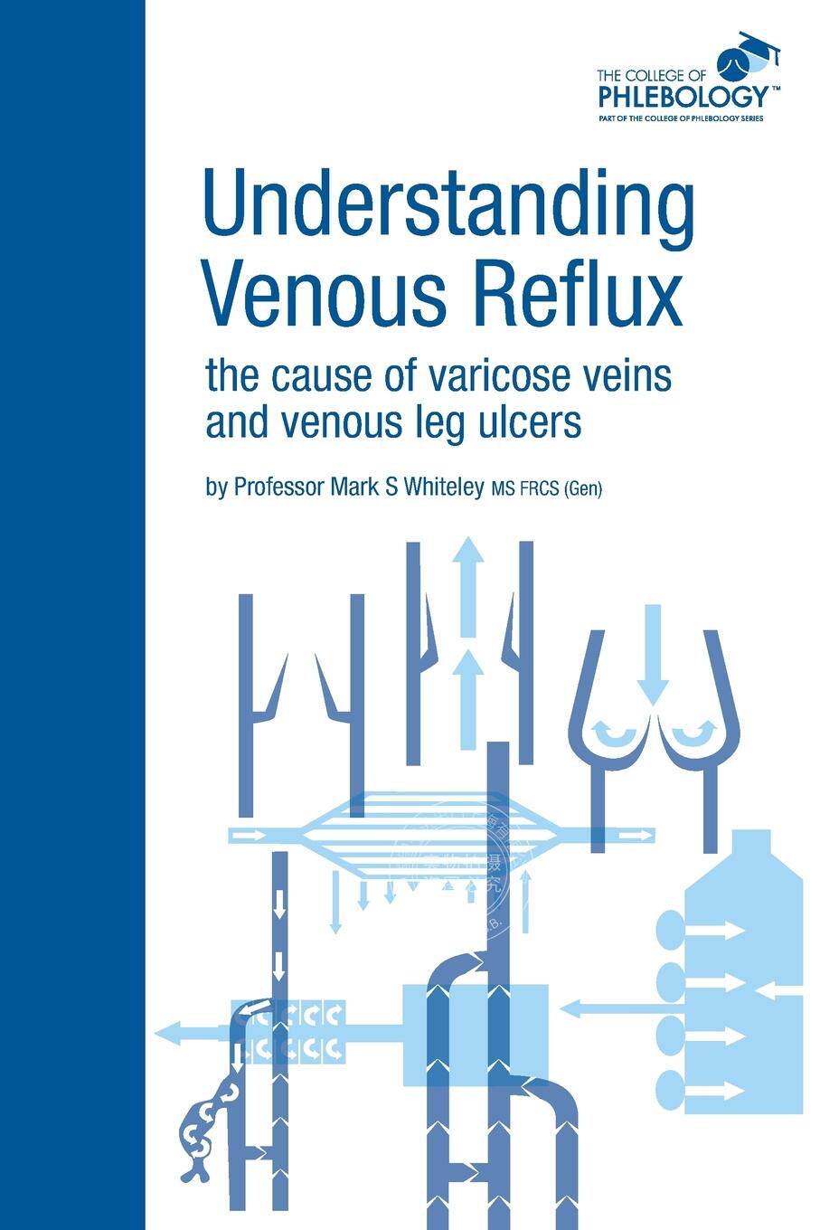 预售 按需印刷 Understanding Venous Reflux the Cause of Varicose Veins and Venous Leg Ulcers