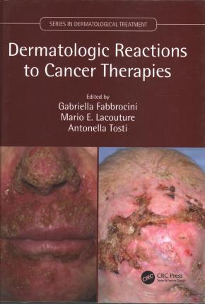 预售 按需印刷 Dermatologic Reactions to Cancer Therapies