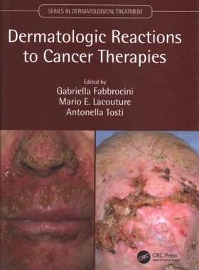 预售 按需印刷 Dermatologic Reactions to Cancer Therapies