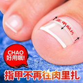 正甲贴甲沟嵌甲矫正器炎脚趾甲指甲长肉里贴片专用拉拉神器纠套装