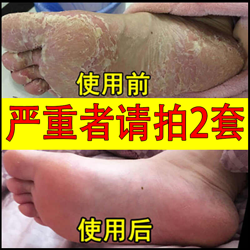 脚气止痒脱皮杀菌真菌感染克星膏保健理疗