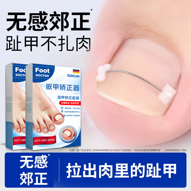 指甲矫正器炎正甲贴嵌甲贴片