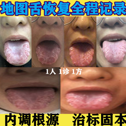 舌头裂纹地图舌调理灼口花纹舌裂纹舌头裂缝舌裂纹舌头地图舌口疮