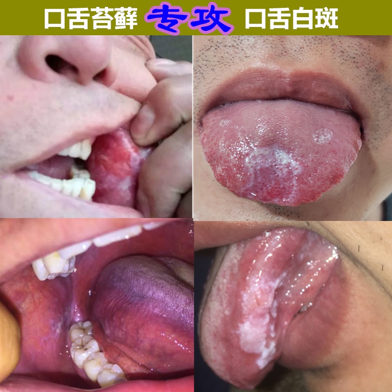 口舌白斑口舌扁平藓口腔扁平苔癣的药口癣舌藓网纹状苔藓白斑舌头