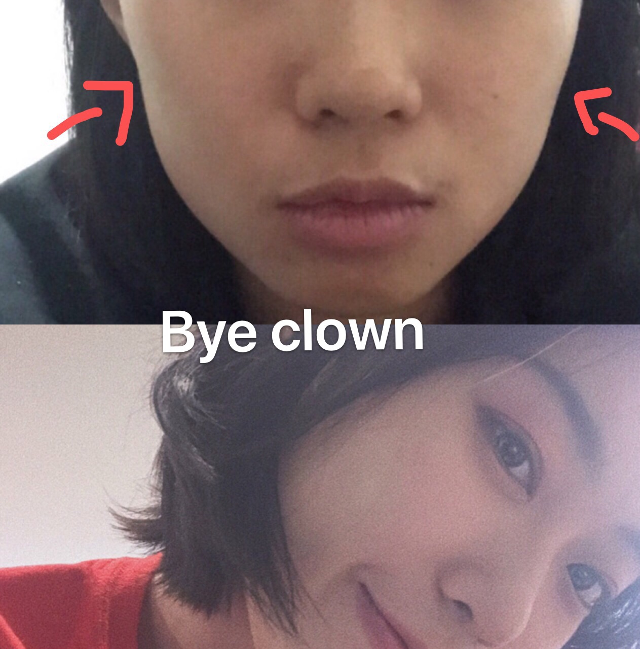 丰脸凹陷丰下巴眉骨额头卧蚕苹果肌眼窝去泪沟法令纹去纹