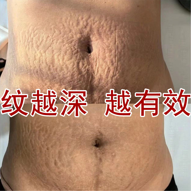 妊娠纹修复霜产后修护去孕纹淡化身体乳/霜