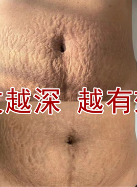 妊娠纹修复霜产后修护去孕纹淡化肥胖纹生长纹紧致膏祛舒缓疤痕膏
