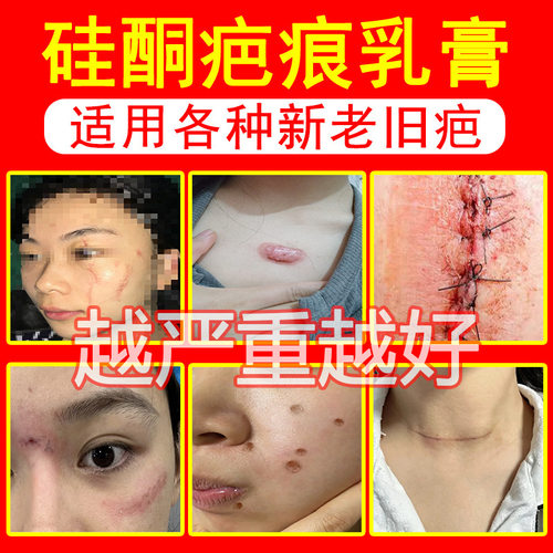 疤痕膏去旧疤伤疤膏祛修护增生疤烫伤疤剖腹产手术疤美容院疤痕膏