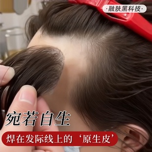 头部伤疤疤痕真发补发贴片隐形无痕假发块定制粘贴在头上的假发片