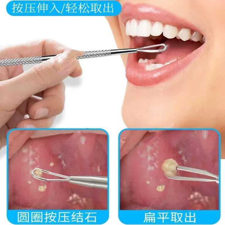 口腔扁桃腺扁条体扁导体石清理器扁桃体结石去除工具取出隐窝神器