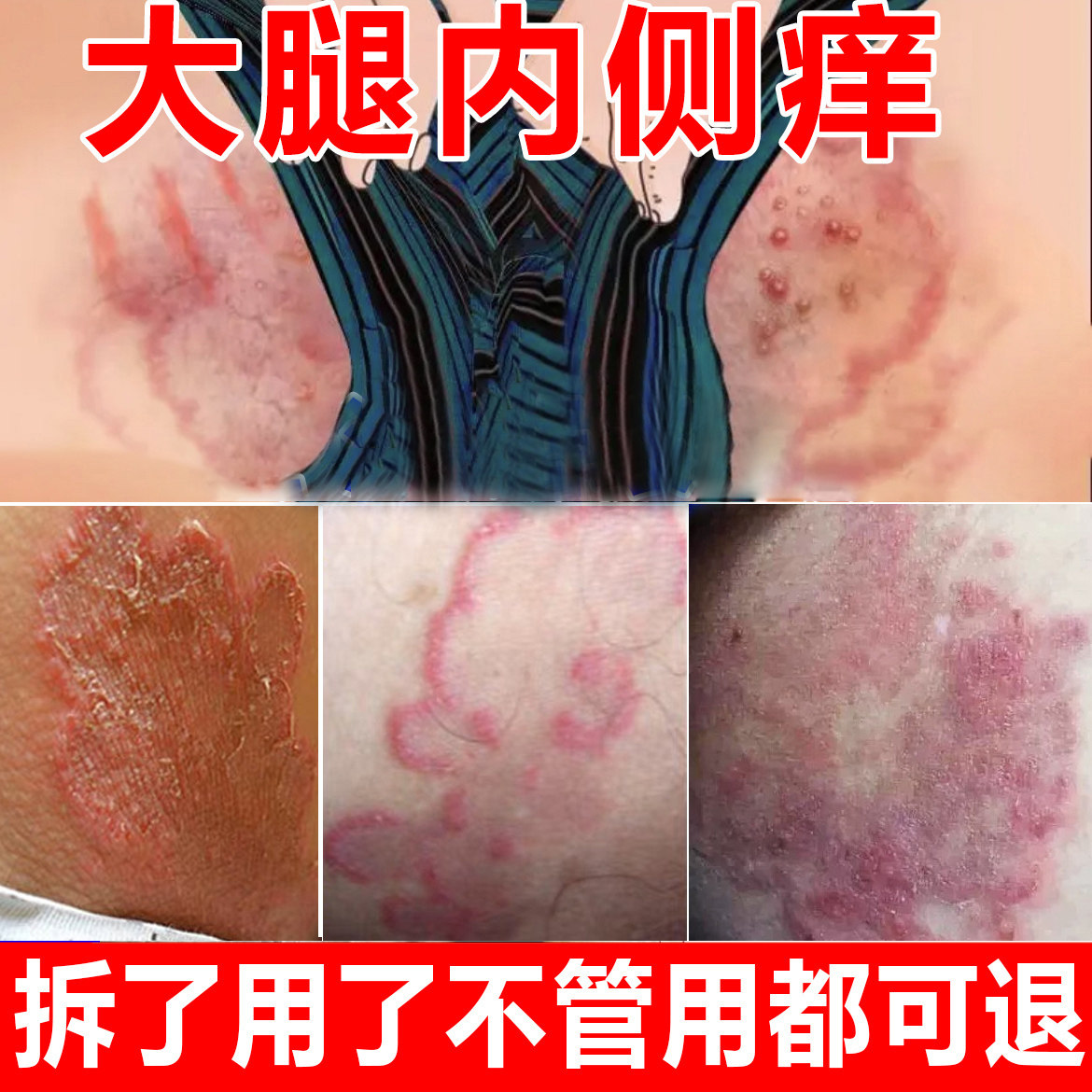 股藓大腿内侧瘙痒专用私处皮肤湿痒红疹脱皮腿根部真菌感染套装