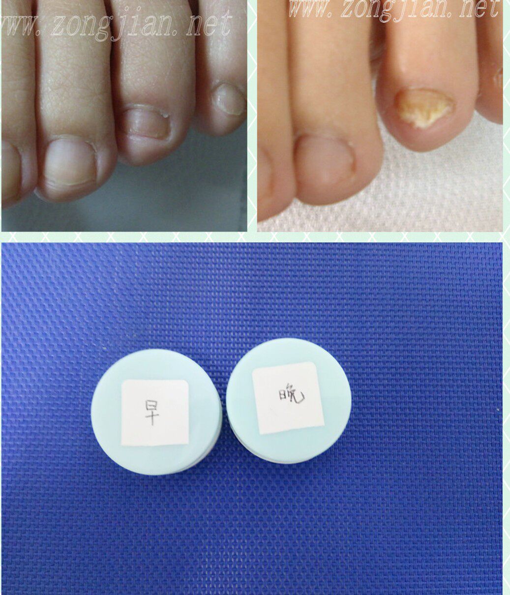 包邮北京宗健 灰甲 轻度  趾甲黄 修脚护理  早晚2盒