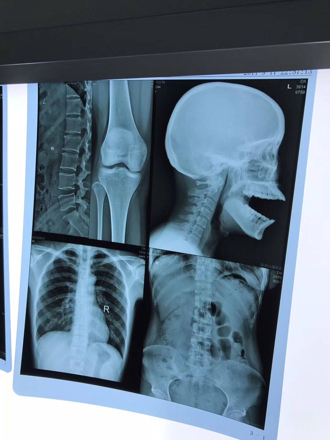 医用彩超x光片dr ct胶片代打印电影电视小品道具教学用实拍210g