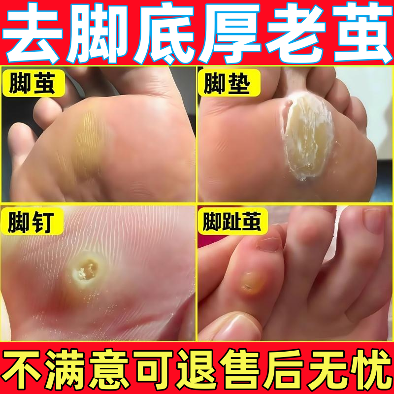 去除厚脚垫老茧死皮脚钉祛除膏根去脚底板脚掌趾指头硬皮软化剂药