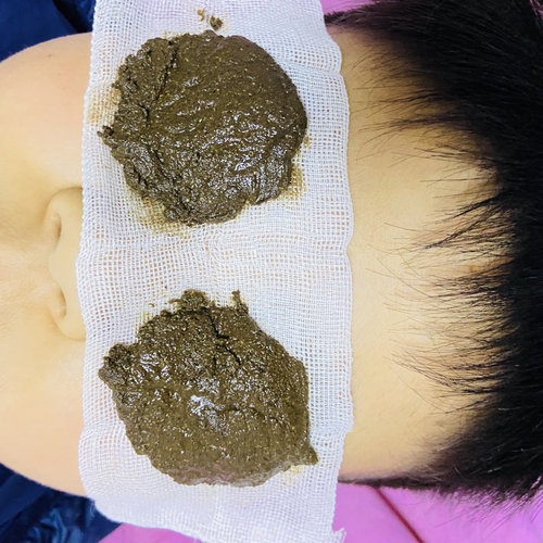 纯中药外敷粉舒缓疲劳眼睛散光弱视近视酸痛干涩症眼角痒流泪眼贴