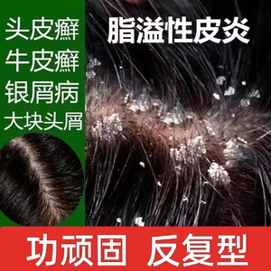 治头部头癣大块头皮屑藓红疙瘩脂溢性皮毛囊发炎止痒药膏非洗发水