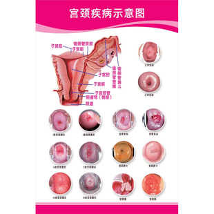 宫颈疾病示意图 女性生殖器系统解剖图女性子宫图片妇科海报挂图