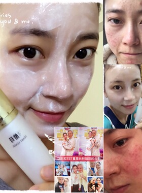 TST活酵母新生面膜乳抗痘缩毛孔提亮肤色修复