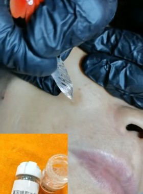 冰晶提取液5ml做胎记肉1痣当场可以去除咖啡胎记这款推荐