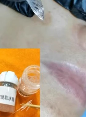 冰晶提取液5毫升，这款做胎记肉痣当场可以去除咖啡胎记这款推荐