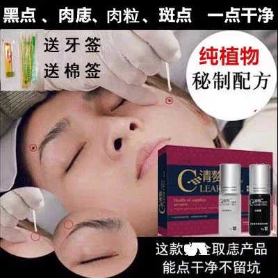清赘去痦子药水点志膏无痕正品跖尤小肉粒疙瘩丝尤肉球休子黑点