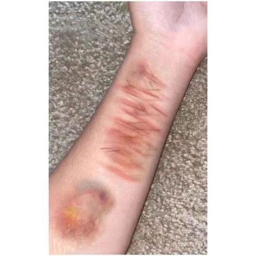 淤青伤病态美学伤疤纹身贴万圣节派对妆容酒吧纹身逼真3D疤痕贴