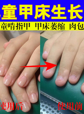 儿童指甲生长液指甲短小断裂甲床萎缩啃咬倒刺分层营养不良修复油