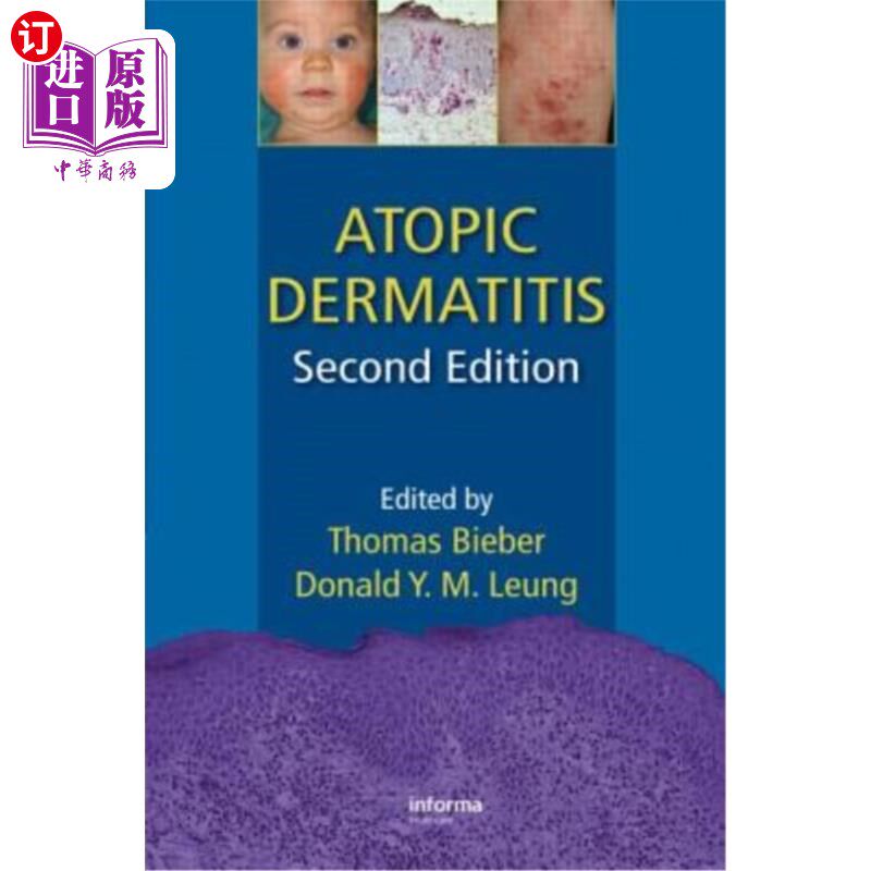 海外直订医药图书Atopic Dermatitis 特应性皮炎