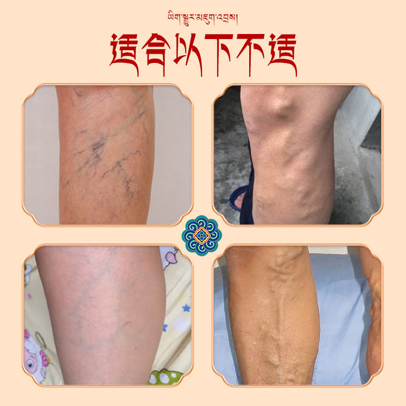 静脉曲贴青筋突出蚯蚓腿扩张酸麻肿胀腿曲张膏液下肢静脉舒滚珠液,运动/瑜伽/健身/球迷用品,其他运动护具,淘宝优惠券,粉丝福利购,淘宝优惠卷
