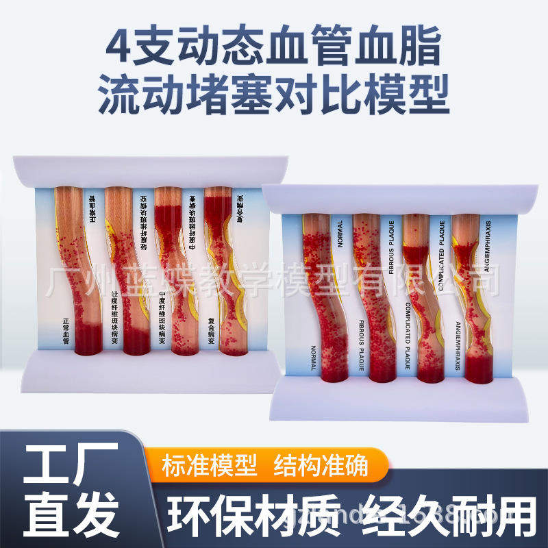 血管仿真堵塞血脂直观高血脂病理动态硬化动脉血栓模型教学流动